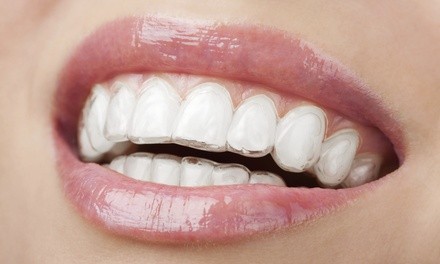 Up to 80% Off on Braces - Invisible - Branded (Invisalign) at Premier Dental Group PLLC of Knoxville