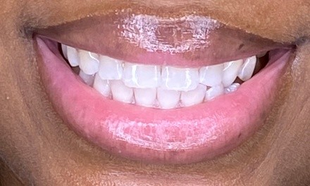 Up to 50% Off on Teeth Whitening - In-Office - Branded (Zoom, Brite Smile) at Charm’d Toothology