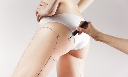 Laser Liposuction Treatments at L. Marcel Body & Wellness Studio (Up to 92% Off). Three Options Available.