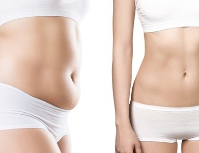 Up to 68% Off on Fat Reduction - Non-Branded at Babe Body Sculpt