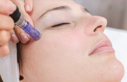 Up to 60% Off on Micro-Needling at Beauty & Soul spa