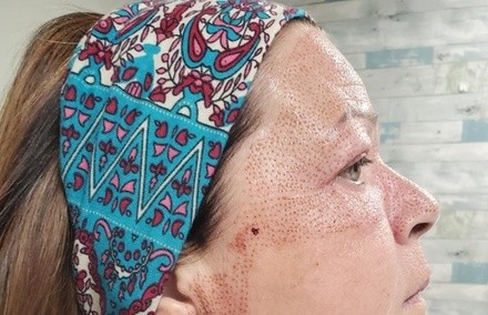 Up to 50% Off on Facelift - Non-Surgical at Ventura Skin Tightening