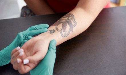One Tattoo-Removal Session on a Small, Medium, or Large Area at The Skin Station (Up to 47% Off)