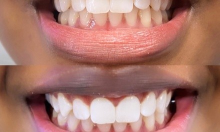 Up to 50% Off on Teeth Whitening - In-Office - Non-Branded at Luxe Twenty Four Beauty Bar