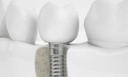 One or Two Dental Implants with Crowns at Brighter Smile Dentistry, (Up to 98% Off)