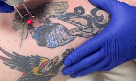 Up to 53% Off on Tattoo Removal at Bad Ink Laser Clinic