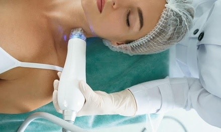 One 60-Minute Radio-Frequency Microneedling Treatment for Full Face and Neck at BB Aesthetic (Up to 28% Off)