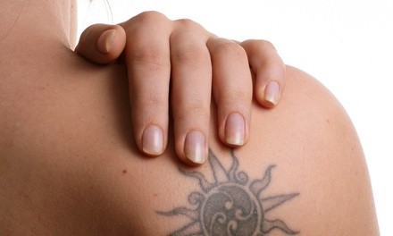 Up to 68% Off on Tattoo Removal at Red Diamond Laser Tattoo Removal