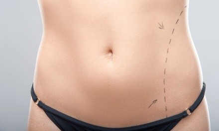 Liposuction on a Small, Large, or Both Areas at Goals Plastic Surgery (Up to 30% Off)