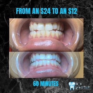 Up to 49% Off on Teeth Whitening at Icy Whites