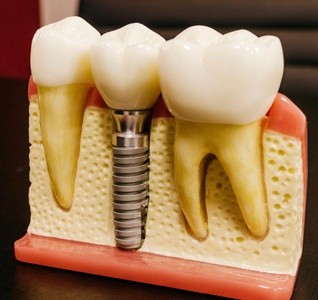 Up to 70% Off on Dental Implant / Corona / Veneer at Sparkling Smile Dental