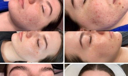 Up to 43% Off on Acne Treatment at Hope Esthetics