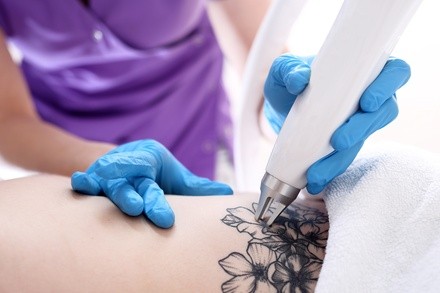 Up to 75% Off on Tattoo Removal at Ka Lani Aesthetics