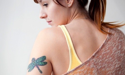 Laser Tattoo-Removal Treatments at Jack & Jill Aesthetics (Up to 62% Off)