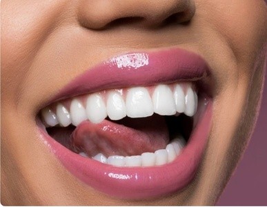 Up to 45% Off on Teeth Whitening - In-Office - Non-Branded at Celebrity Smiles Whitening Bar