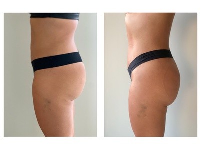 Up to 37% Off on Ultrasonic Fat Reduction at Bodysculpting by Janice