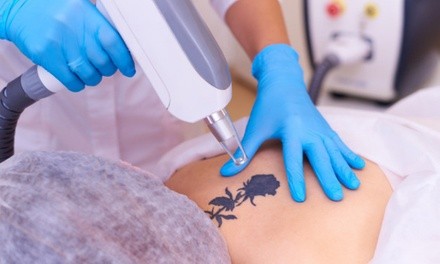 Three Sessions of Laser Tattoo Removal: 1'', 2,'', 3'', 4'', or 5'' Round at Tap & Zap Laser Spa (Up to 30% Off)