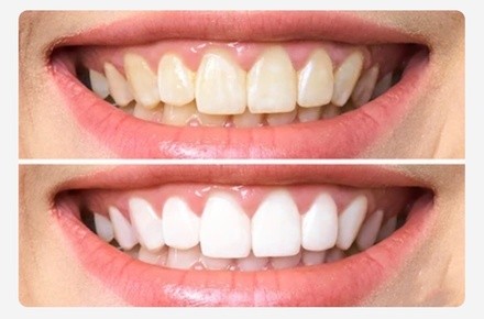 Up to 20% Off on Teeth Whitening at Flowering Beauty Artistry
