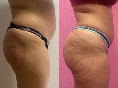 Up to 50% Off on Brazilian Butt Lift at Vida Mia Aesthetics