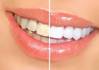Teeth Whitening or Tooth Gem Session at Everbrite Teeth Whitening Salon (Up to 30% Off). Four Options Available.