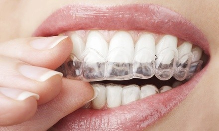 $39 for Invisalign Braces with Retainer and Professional Whitening Kit at Stunning Smiles ($2,516 Value)