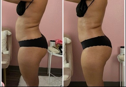 Up to 65% Off on Ultrasonic Fat Reduction at Bella Dama Body Contour