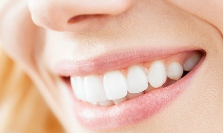 Up to 50% Off on Teeth Whitening - In-Office - Non-Branded at KKLUXURYSTUDIO