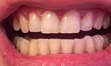 Up to 52% Off on Teeth Whitening at Adrijanas Salon