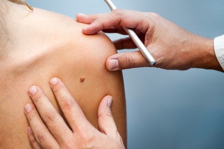 Up to 44% Off on Mole / Growth Removal at Serenity Beauty Co