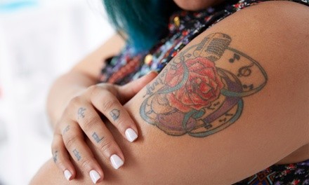 Laser Tattoo Removal at Severn River Medispa and Laser Center (Up to 75% Off). Six Options Available.