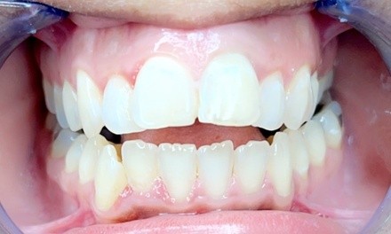 Up to 50% Off on Teeth Whitening - Traditional at Unlimited Teeth Whitening