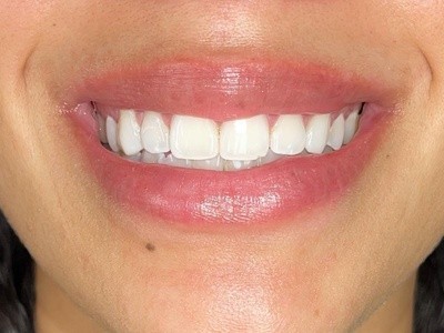 Up to 30% Off on Teeth Whitening - In-Office - Non-Branded at LoveLee Bodies
