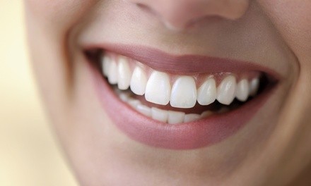One 30- or 60-Minute In-Office Davinci Laser Teeth Whitening Treatment at Simply Amazing Spa (Up to 31% Off)