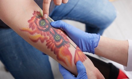 Three Tattoo-Removal Sessions on an Extra-Small, Small, Medium, or Large Area at Renu MedSpa (Up to 63% Off)