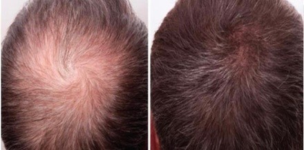 Up to 40% Off on Hair Restoration - Non-Surgical at Brows By Leah LLC