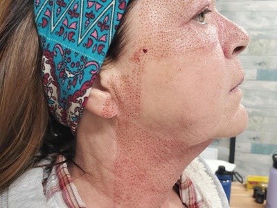 Up to 50% Off on Facelift - Non-Surgical at Ventura Skin Tightening