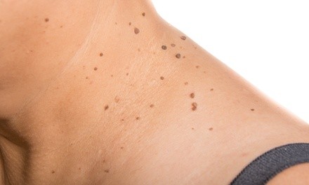 One or Two Skin Tag or Milia Removals at Skin Care Lounge by Iliana (Up to 80% Off)