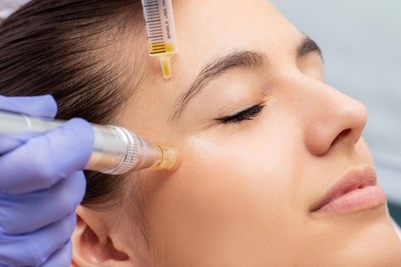Up to 44% Off on Micro-Needling at Skin Care Spa at Tiffany's