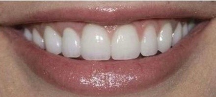 Up to 25% Off on Teeth Whitening at Bs Beauty Creation