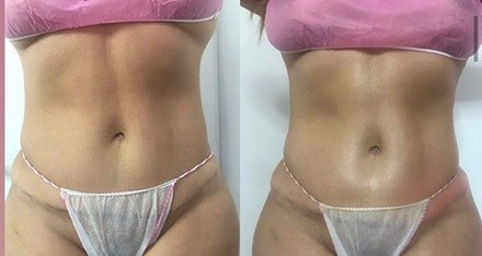 Up to 50% Off on Lipo - Non-Invasive Laser-iLipo at CAMP DollHouse Aesthetics