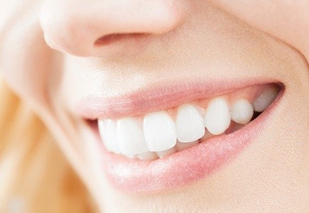 Up to 49% Off on Teeth Whitening at Lace Xclusive Salon Barber & Spa