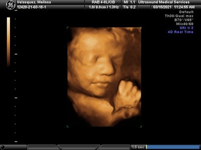 Up to 40% Off on Ultrasound - 3D / 4D at Ultrasound Services